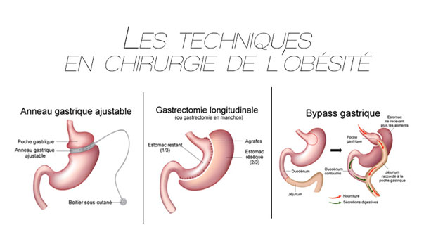 CHIRURGIE DE L'OBESITE