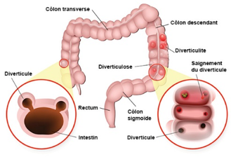 Diverticulose colique et Nutrition