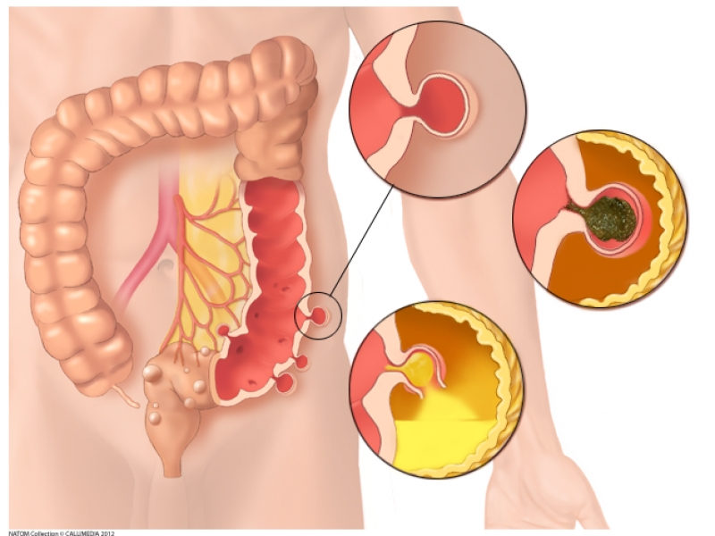 Diverticulose colique et Nutrition